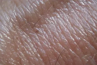 Significant Points About Skin Cancer Avoidance That You Ought To Know