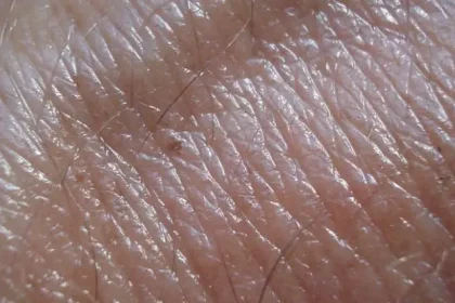 Significant Points About Skin Cancer Avoidance That You Ought to Know