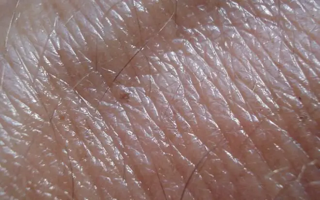 Significant Points About Skin Cancer Avoidance That You Ought to Know